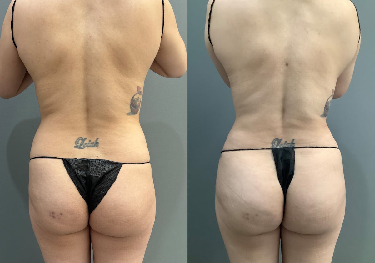 Liposuction Before & After Gallery - Patient 314443 - Image 6