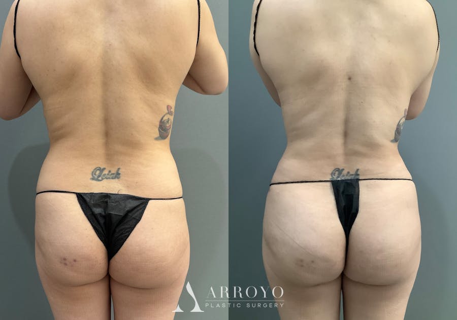 Liposuction Before & After Gallery - Patient 314443 - Image 6