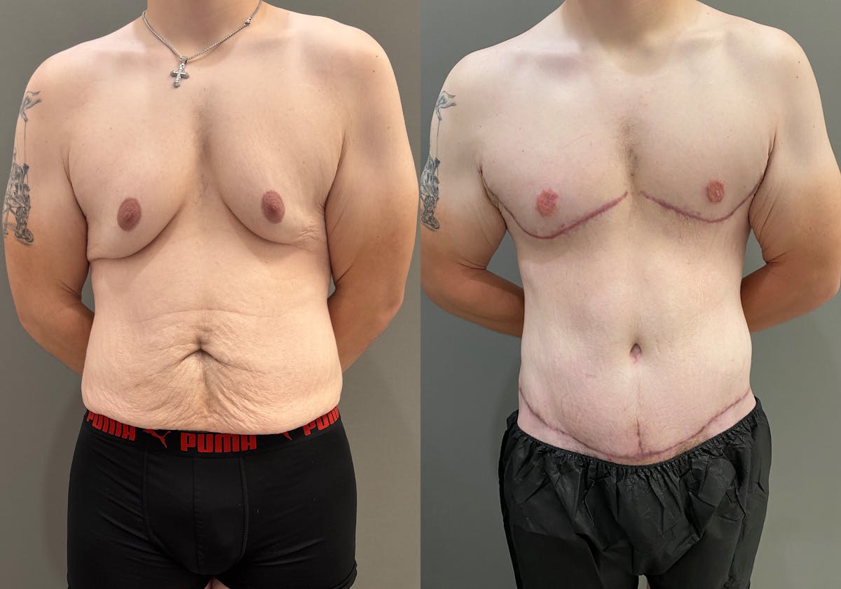 Body Lift Before & After Gallery - Patient 168187 - Image 1