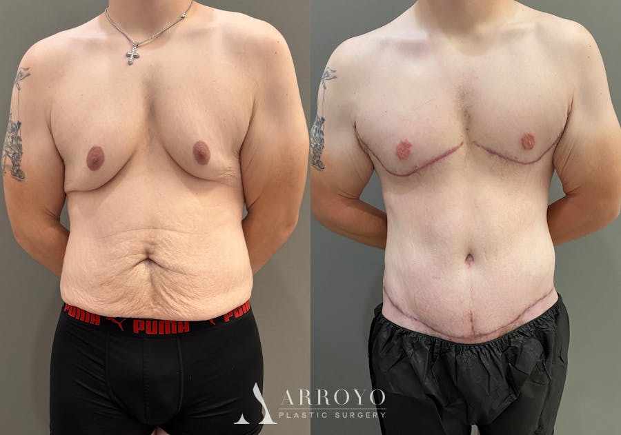 Body Lift Before & After Gallery - Patient 168187 - Image 1