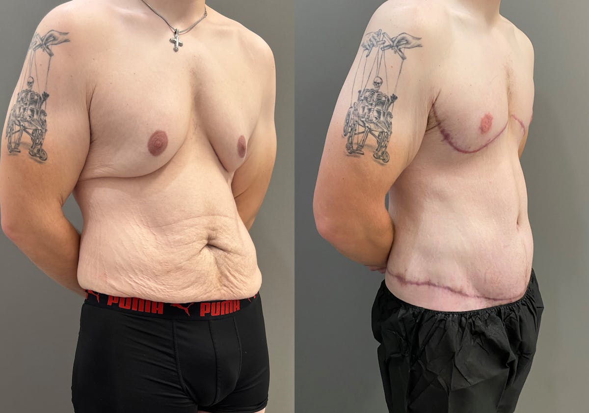 Body Lift Before & After Gallery - Patient 168187 - Image 2