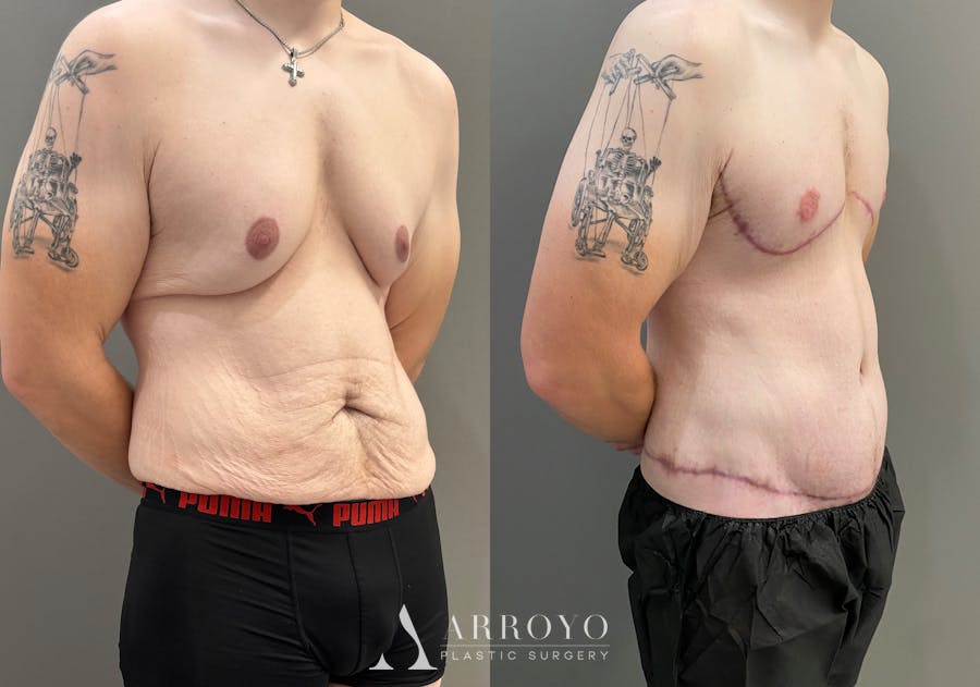 Body Lift Before & After Gallery - Patient 168187 - Image 2