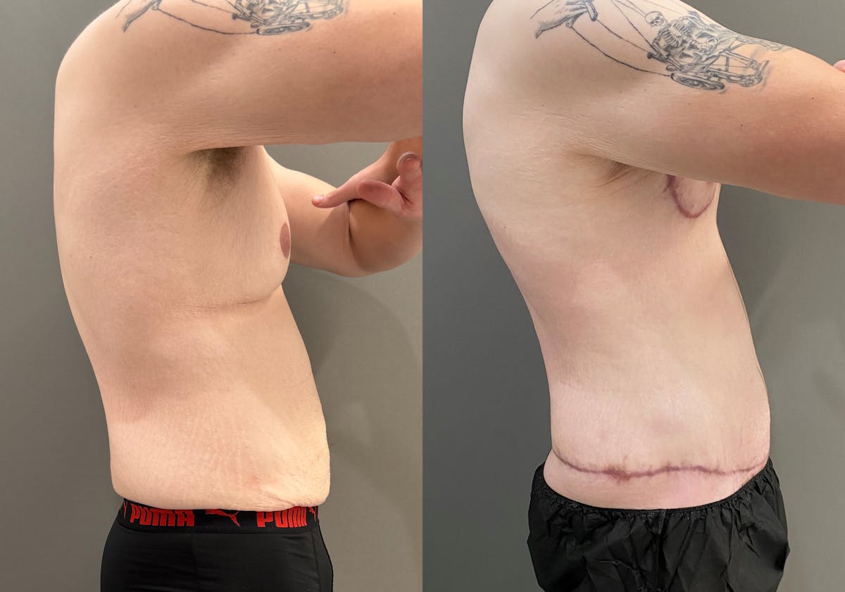 Body Lift Before & After Gallery - Patient 168187 - Image 4