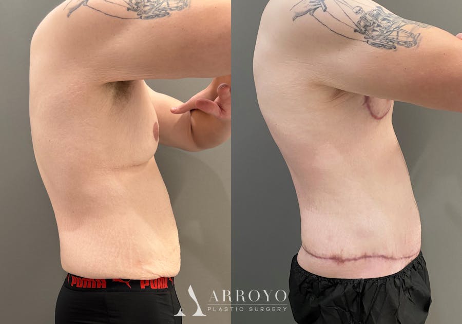Body Lift Before & After Gallery - Patient 168187 - Image 4