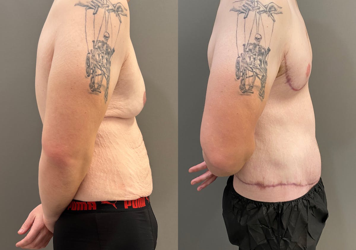 Body Lift Before & After Gallery - Patient 168187 - Image 3