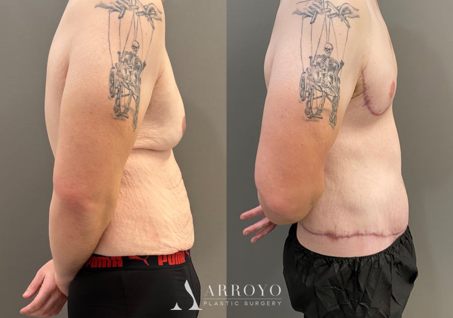 Body Lift Before & After Gallery - Patient 168187 - Image 3