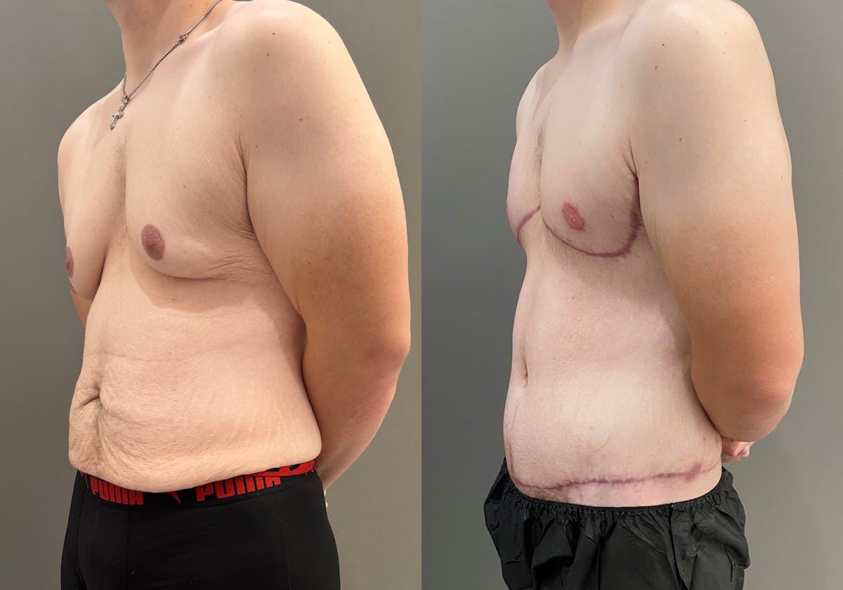 Body Lift Before & After Gallery - Patient 168187 - Image 5