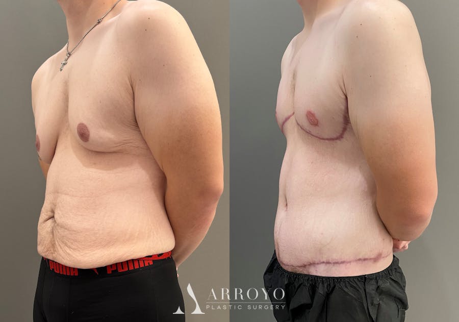 Body Lift Before & After Gallery - Patient 168187 - Image 5