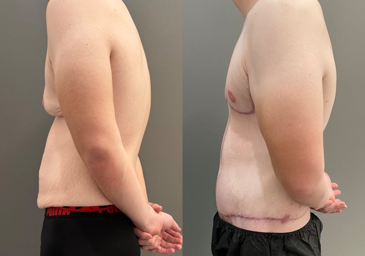 Body Lift Before & After Gallery - Patient 168187 - Image 6