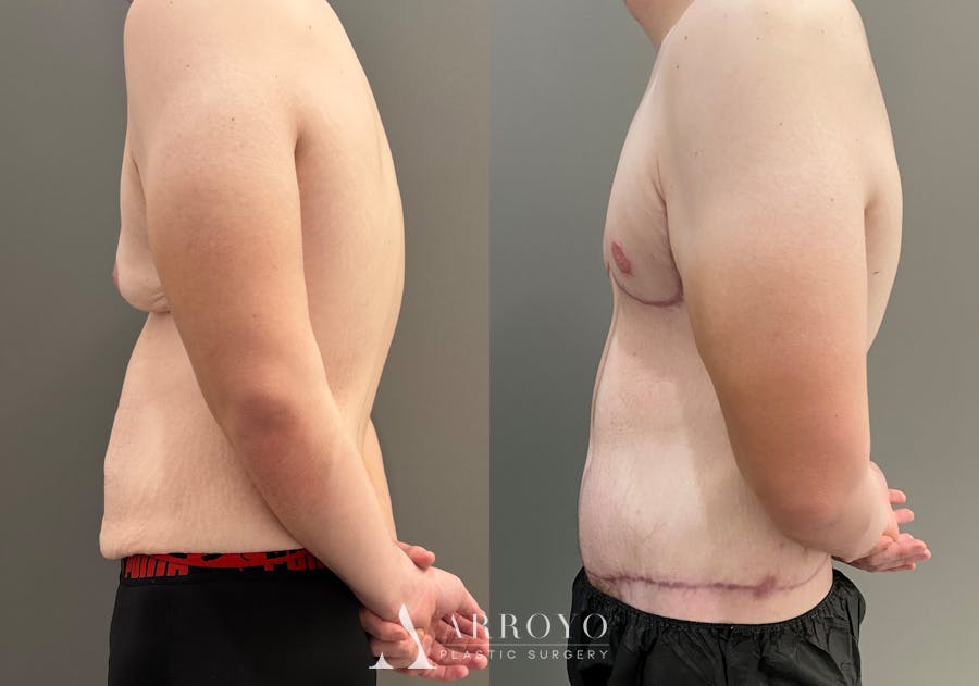 Body Lift Before & After Gallery - Patient 168187 - Image 6