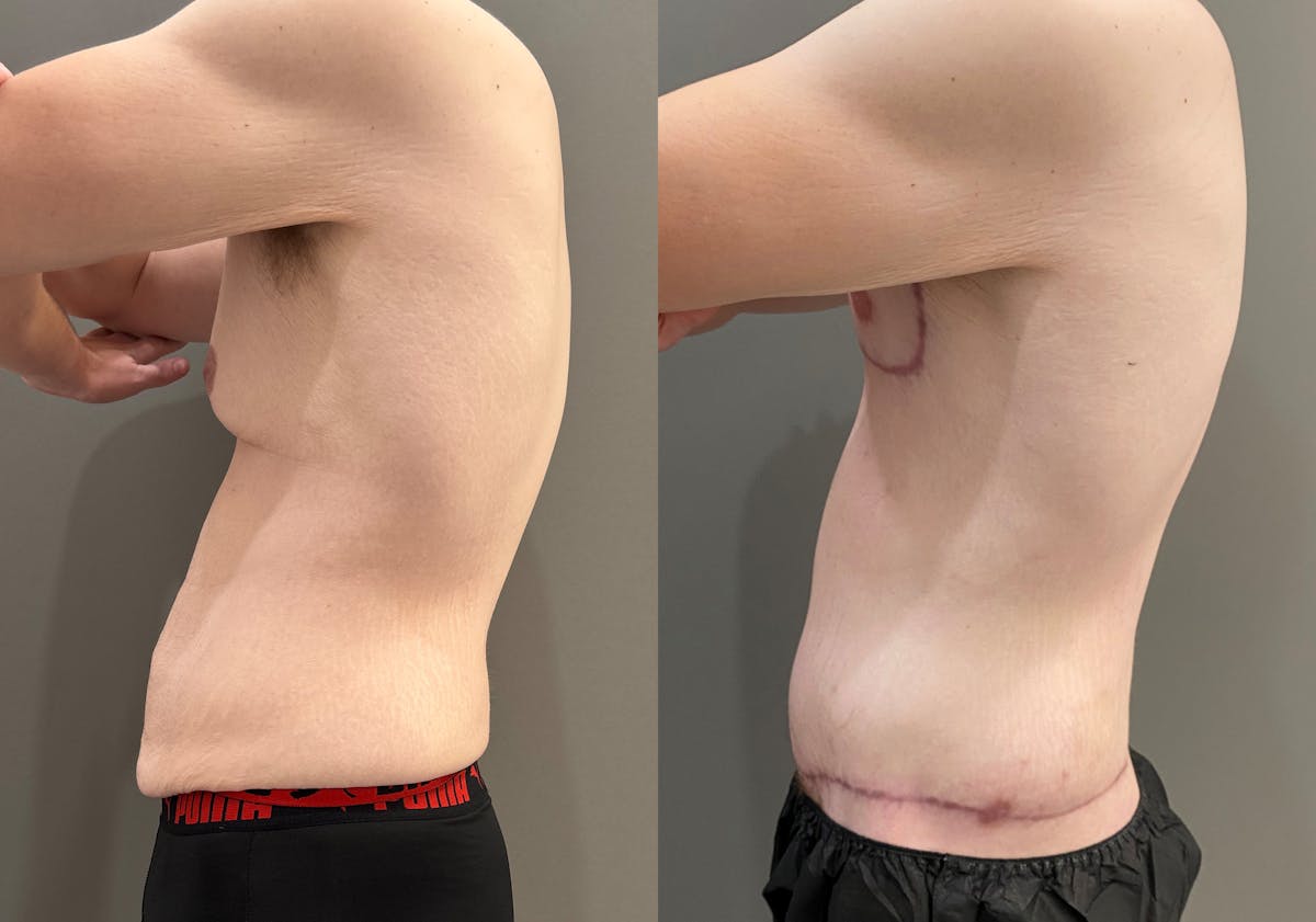 Body Lift Before & After Gallery - Patient 168187 - Image 7