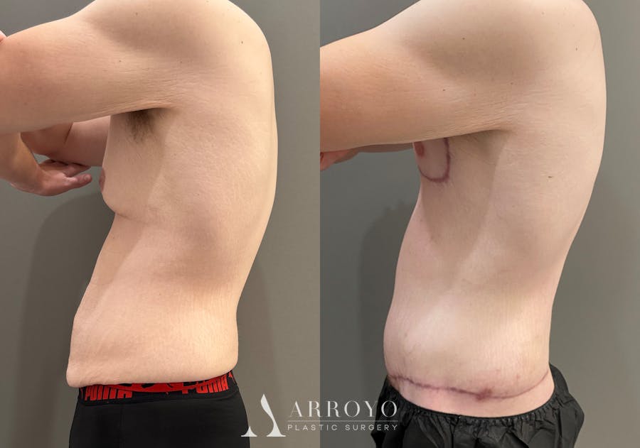Body Lift Before & After Gallery - Patient 168187 - Image 7