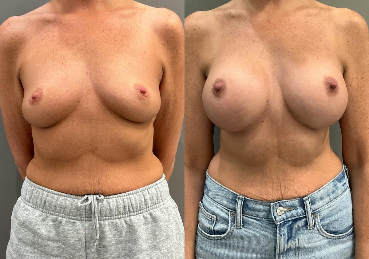 Breast Augmentation Before & After Gallery - Patient 359597 - Image 1