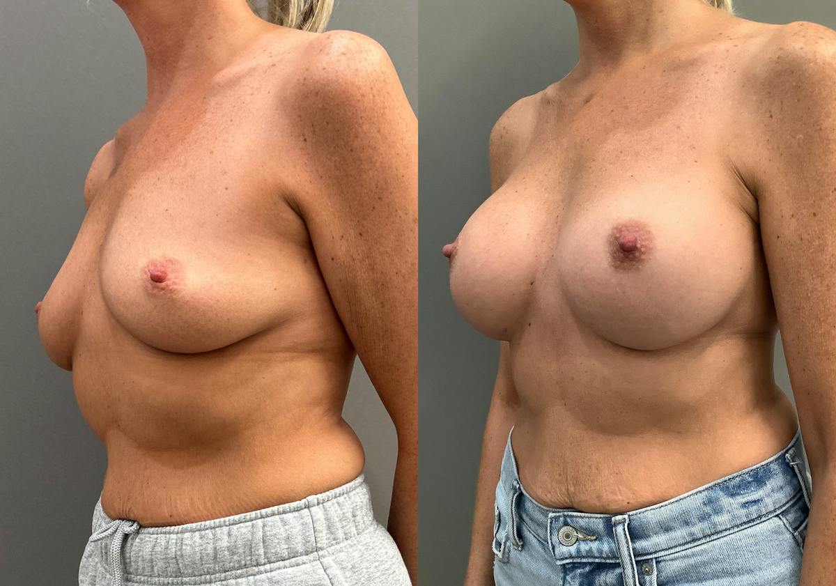 Breast Augmentation Before & After Gallery - Patient 359597 - Image 2