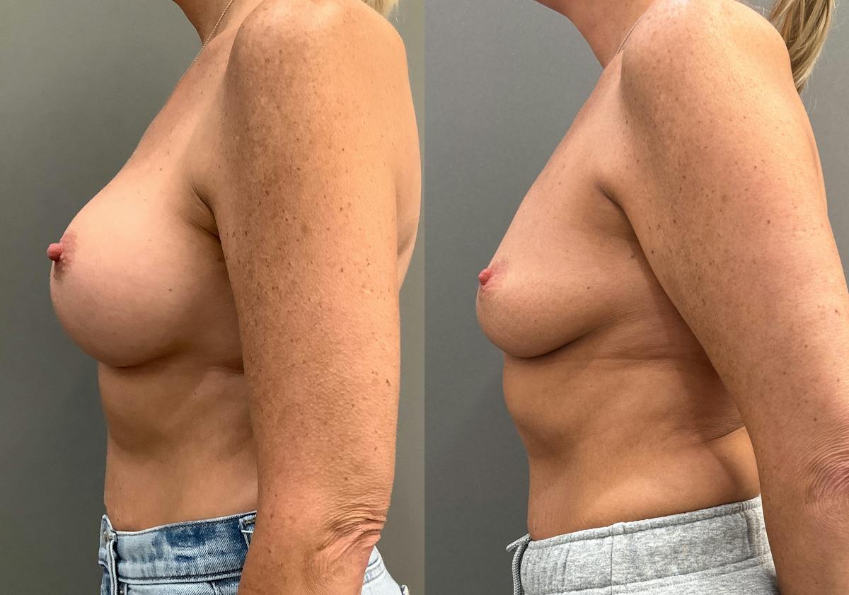 Breast Augmentation Before & After Gallery - Patient 359597 - Image 3