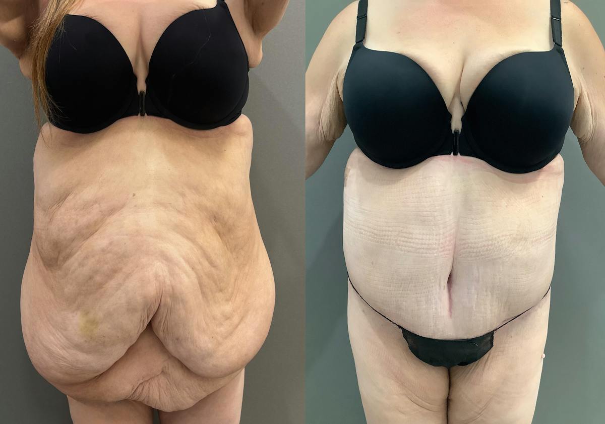 Liposuction Before & After Gallery - Patient 116968 - Image 1