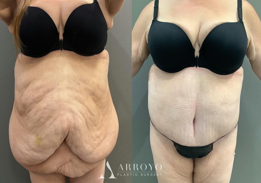 Body Lift Before & After Gallery - Patient 255122 - Image 1