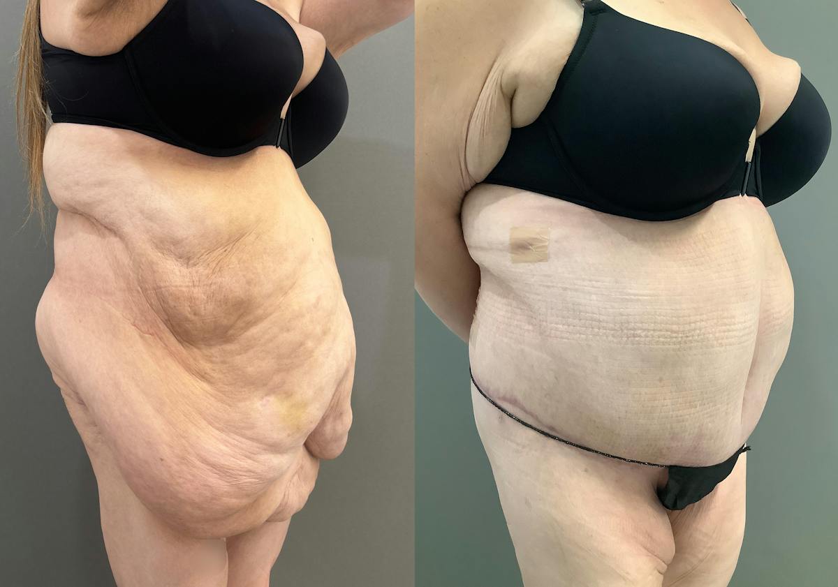 Liposuction Before & After Gallery - Patient 116968 - Image 2