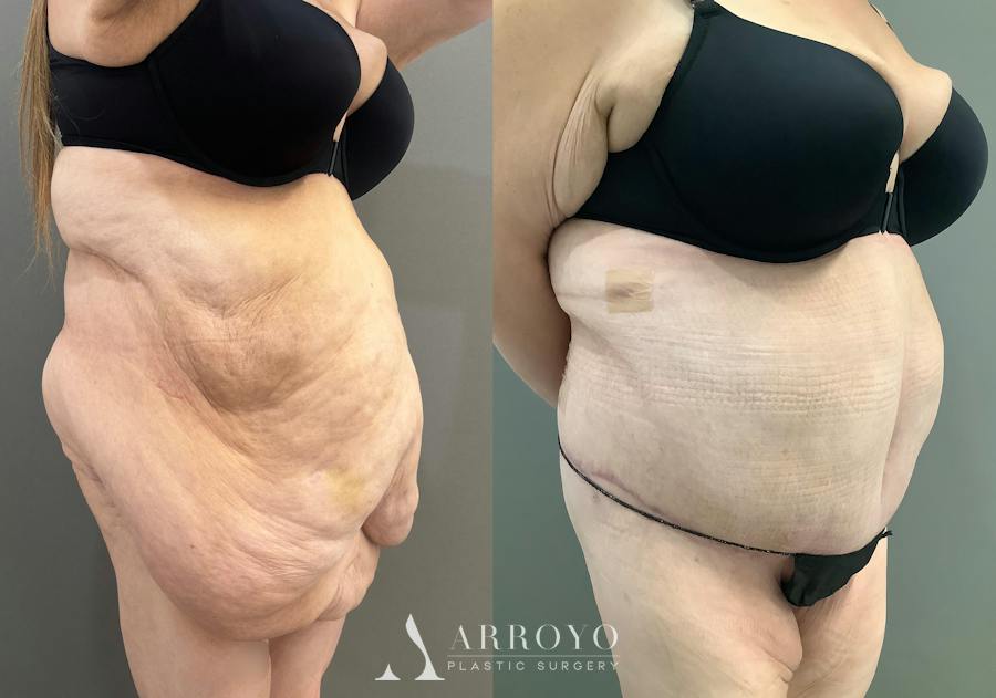 Body Lift Before & After Gallery - Patient 255122 - Image 2