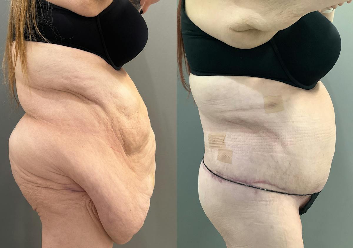 Liposuction Before & After Gallery - Patient 116968 - Image 3