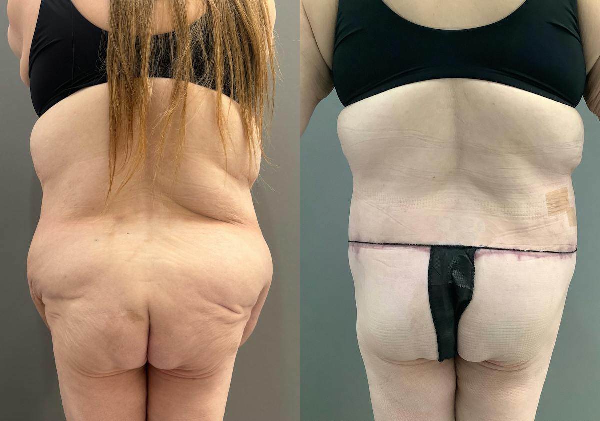 Liposuction Before & After Gallery - Patient 116968 - Image 4