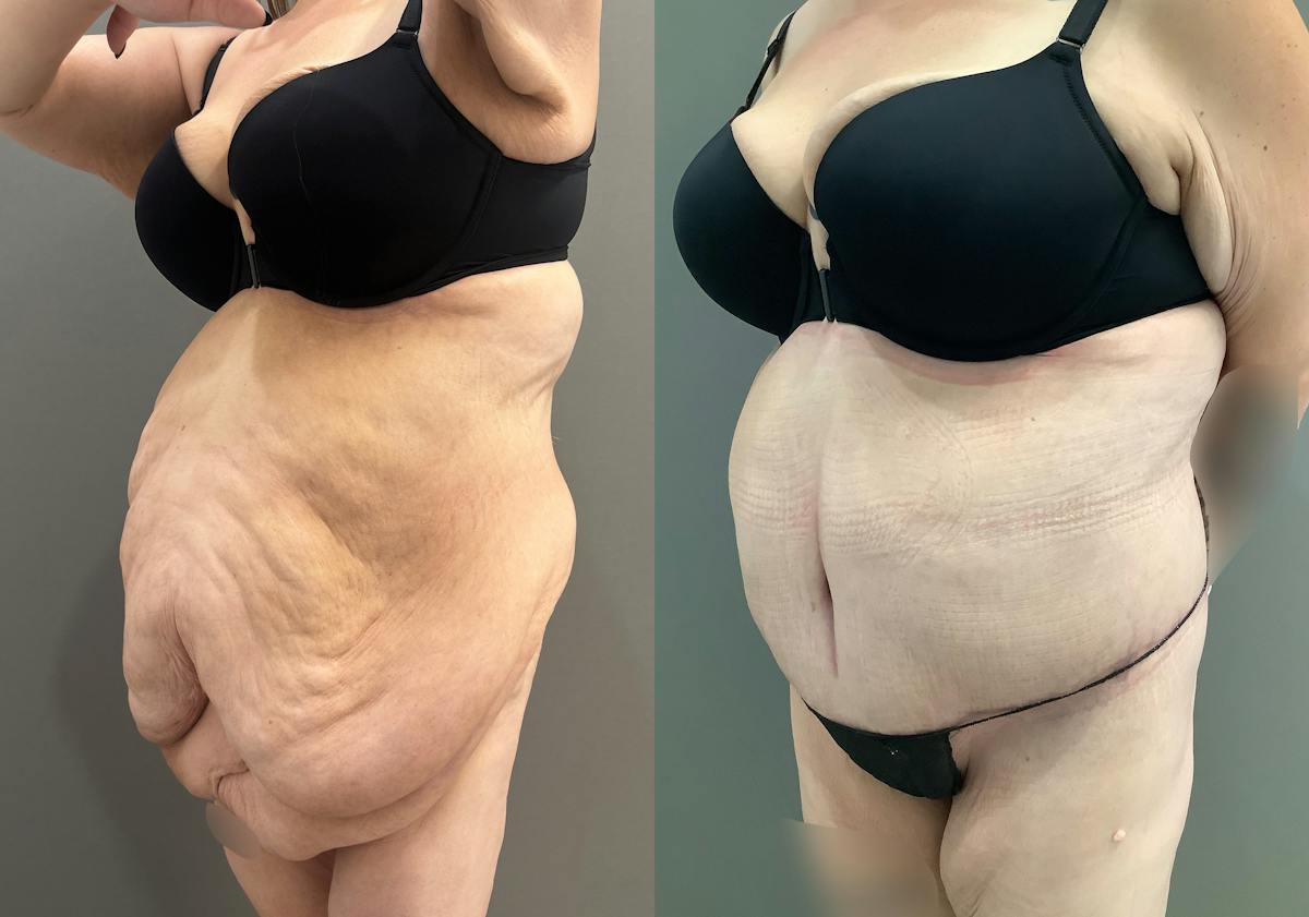 Liposuction Before & After Gallery - Patient 116968 - Image 5