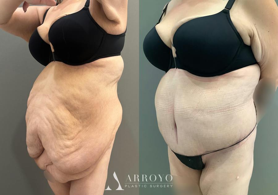 Body Lift Before & After Gallery - Patient 255122 - Image 5