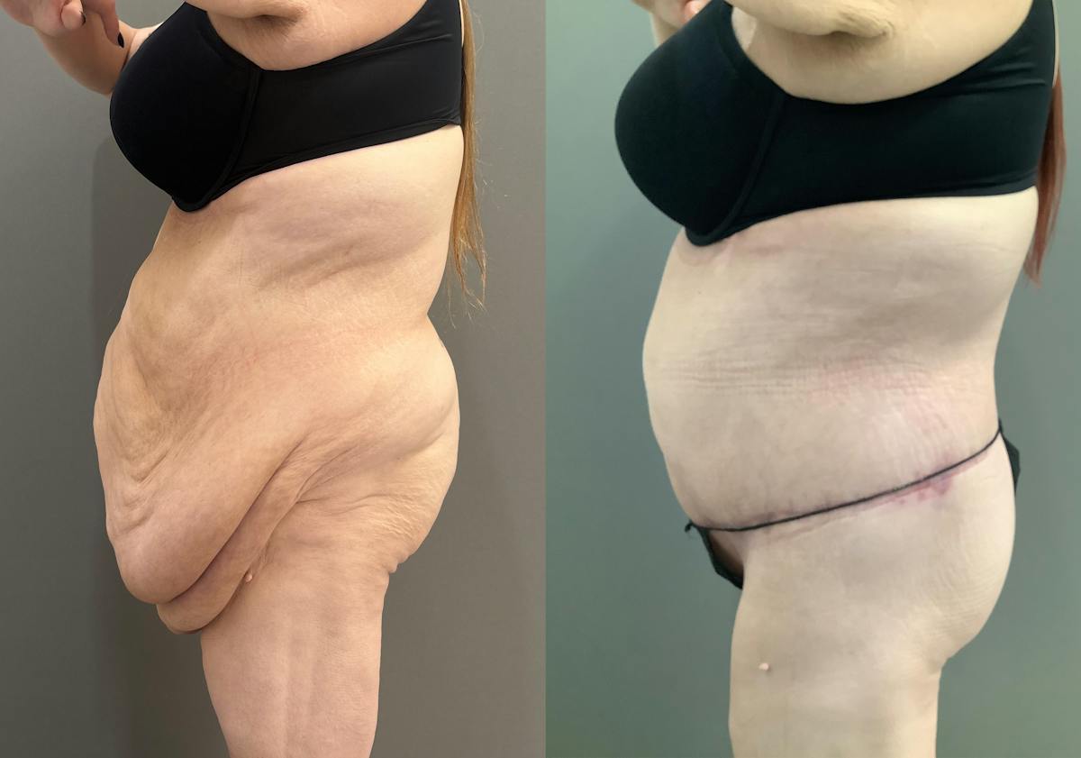Liposuction Before & After Gallery - Patient 116968 - Image 6