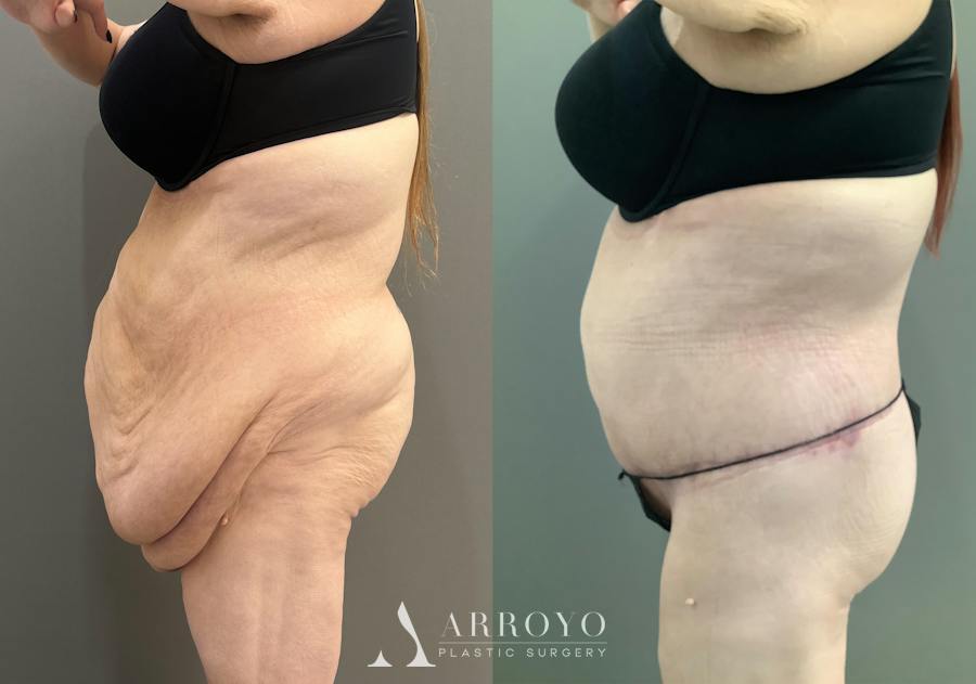 Body Lift Before & After Gallery - Patient 255122 - Image 6