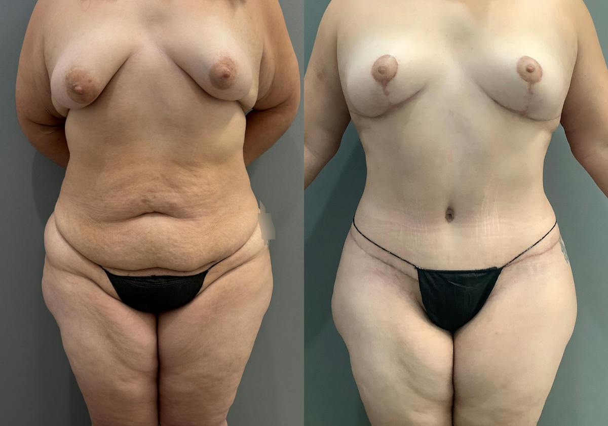 Liposuction Before & After Gallery - Patient 297601 - Image 1