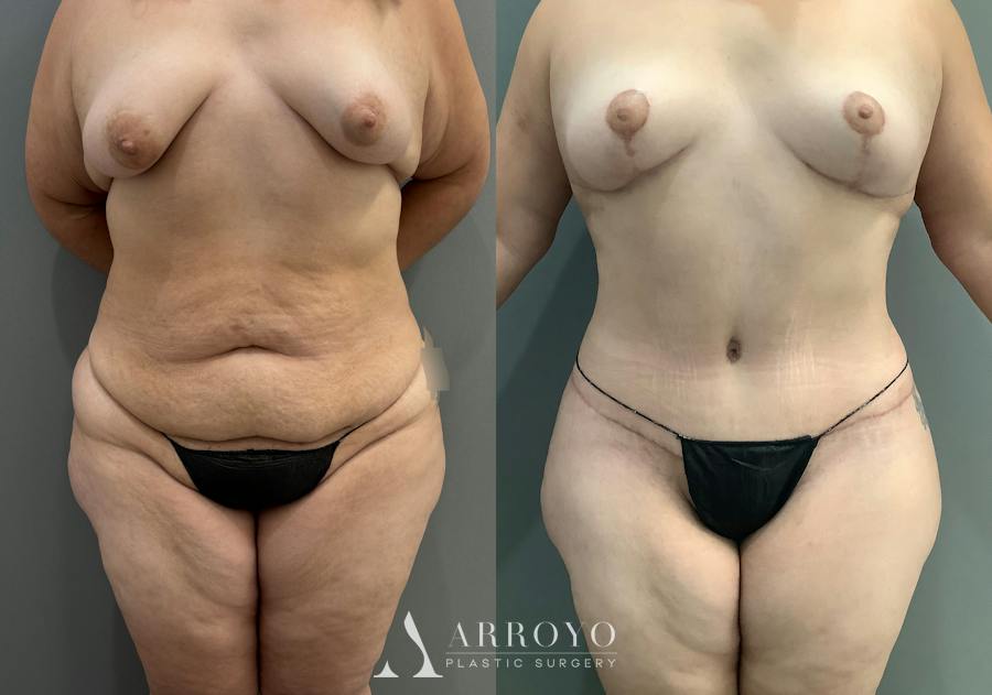 Tummy Tuck Before & After Gallery - Patient 181902 - Image 1