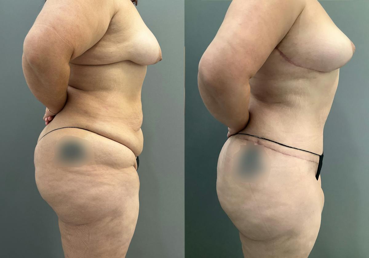 Liposuction Before & After Gallery - Patient 297601 - Image 2