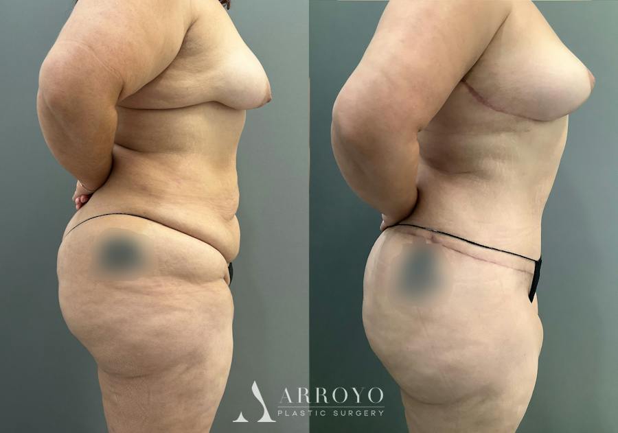 Tummy Tuck Before & After Gallery - Patient 181902 - Image 2