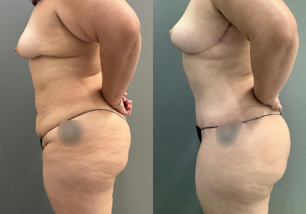 Liposuction Before & After Gallery - Patient 297601 - Image 4