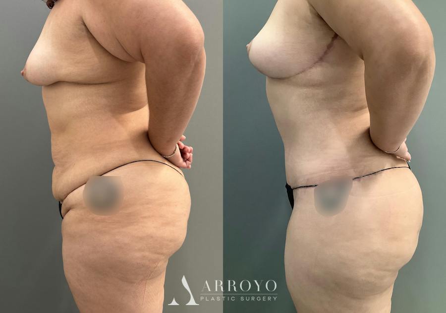 Tummy Tuck Before & After Gallery - Patient 181902 - Image 4