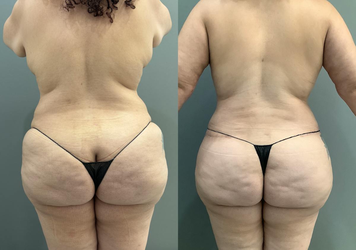 Liposuction Before & After Gallery - Patient 297601 - Image 3