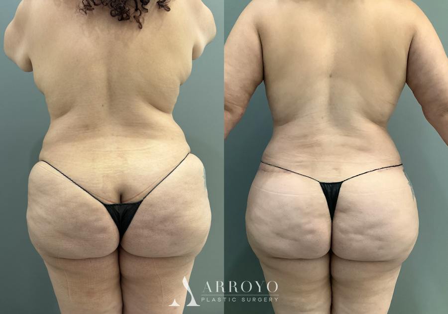 Tummy Tuck Before & After Gallery - Patient 181902 - Image 3