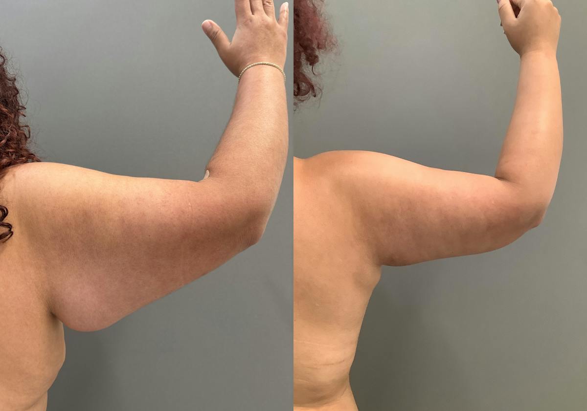 Liposuction Before & After Gallery - Patient 297601 - Image 6