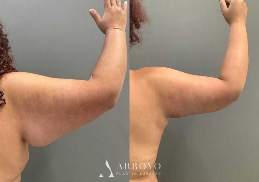 Tummy Tuck Before & After Gallery - Patient 181902 - Image 6