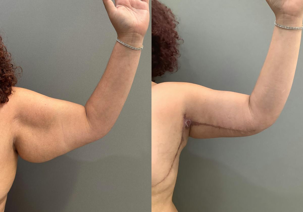 Liposuction Before & After Gallery - Patient 297601 - Image 5