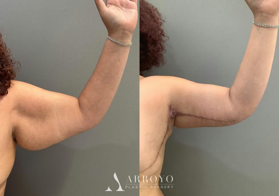 Tummy Tuck Before & After Gallery - Patient 181902 - Image 5
