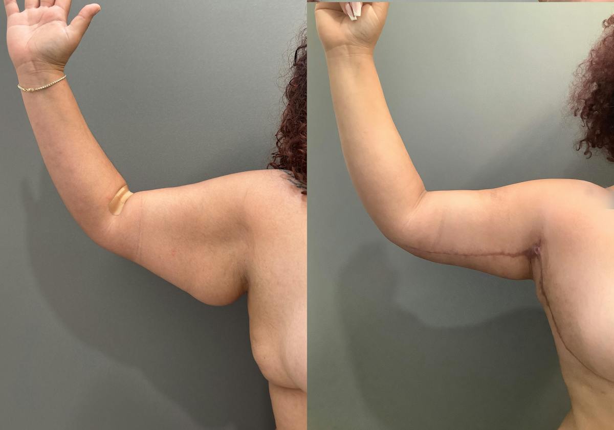 Liposuction Before & After Gallery - Patient 297601 - Image 7