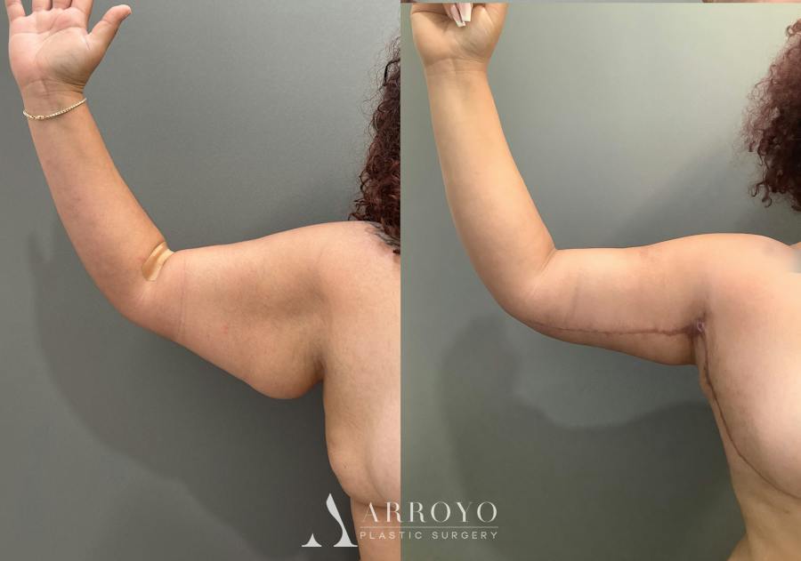 Tummy Tuck Before & After Gallery - Patient 181902 - Image 7
