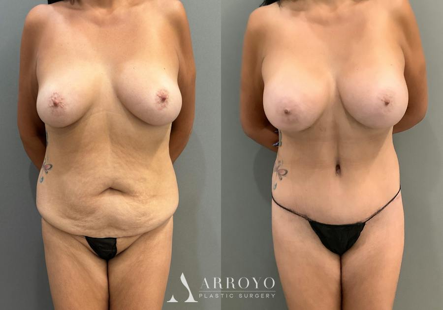 Tummy Tuck Before & After Gallery - Patient 336270 - Image 1