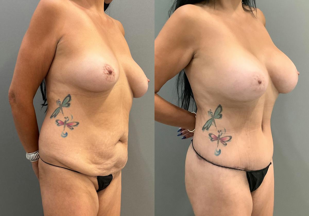 Liposuction Before & After Gallery - Patient 429392 - Image 2