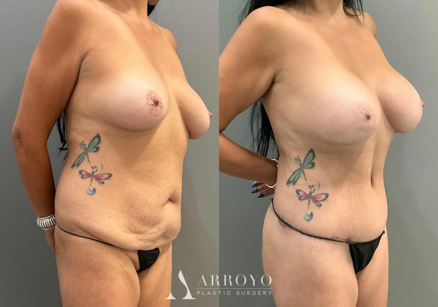 Tummy Tuck Before & After Gallery - Patient 336270 - Image 2