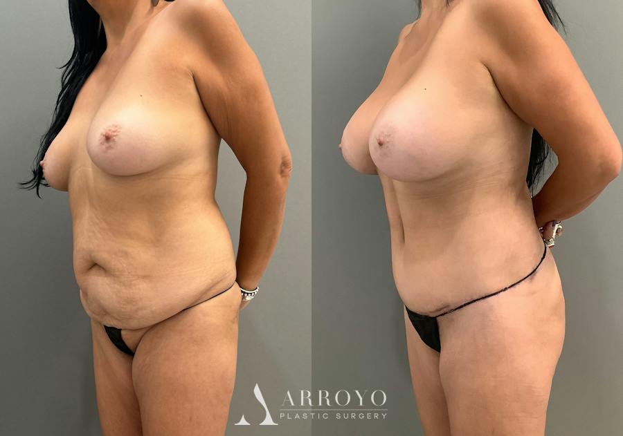 Tummy Tuck Before & After Gallery - Patient 336270 - Image 4