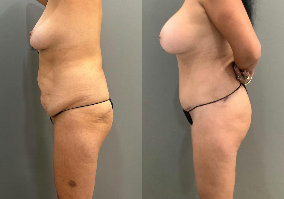 Liposuction Before & After Gallery - Patient 429392 - Image 5