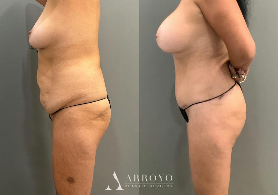 Tummy Tuck Before & After Gallery - Patient 336270 - Image 5