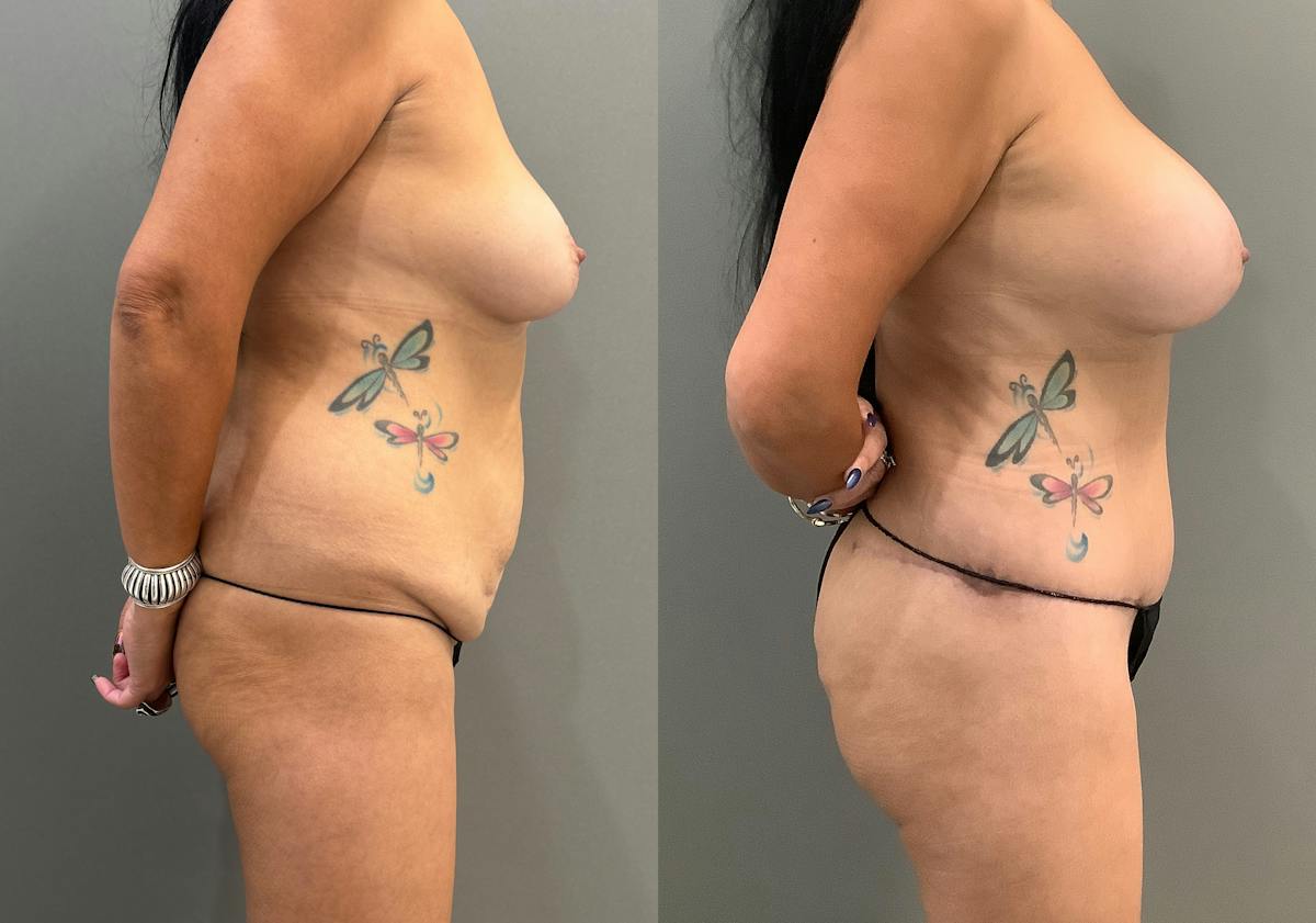 Liposuction Before & After Gallery - Patient 429392 - Image 3